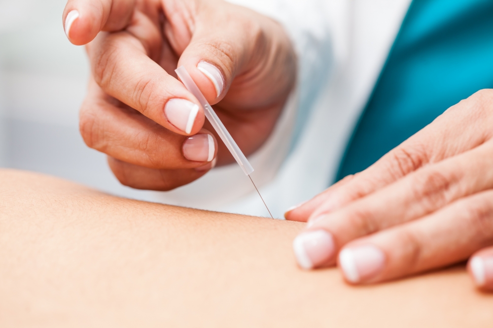 Dry Needling