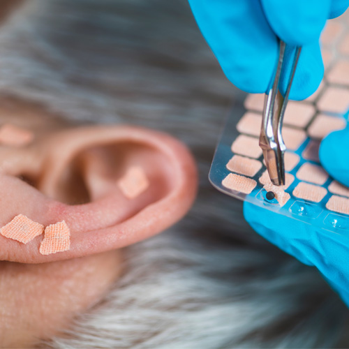 Placing needles or seeds (Wangbuliuxing) on specific points of ear